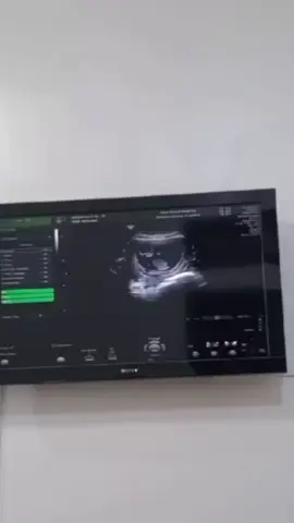 Masyaallah Tabarakallah. Aktifnya adek jalan 4 bulan. Semoga sehat terusss😘🫶🏻 #USG #bumilsehat 