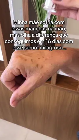 16 dias, do melhor serúm da vida e tivemos resultados incríveis.  #serum #skincare #routine #manchasnapele 