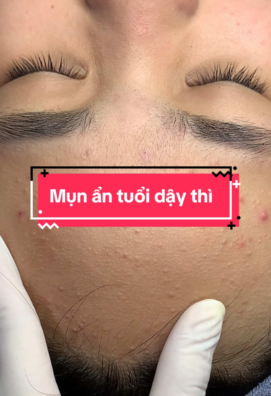 Mụn ẩn tuổi dậy thì#xuhuong #dieutridakhoahoc #nanmunbangtay #nanmunbangtayuytinhanoi #mesotherapy #peel #fyp 
