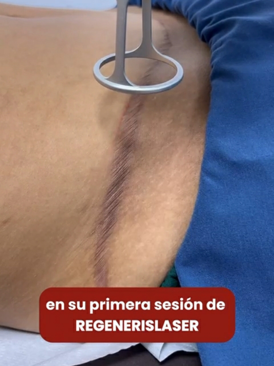 Mira como Regenerislaser mejora las cicatrices 😊👏 #tratamiento #cicatriz #cicatrices #keloid #keloids #lima #limaperu 
