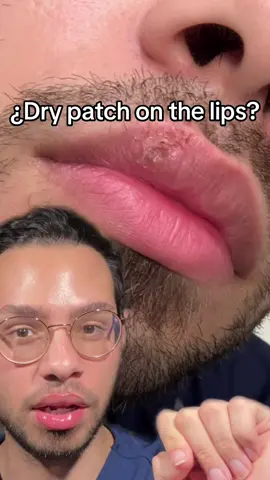 Dry lips cause by contact dermatitis ( eczema ) 👁️👁️ #beauty #skincare 
