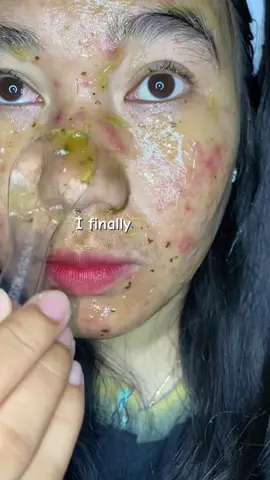 Akhirnya🥹✨ #fyp #trending #acreproneskin #masker 