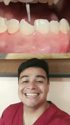 Quebrou Um Pedaço Do Seu Dente!? Faça Isso!  ‎@dr.morad.shaglouf #short #odontologia #dente #dentista #fy #odonto #restauracao   