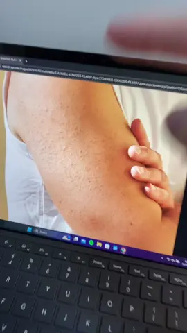 HURRY BEFORE ITS GONE!!! #theordinary #glycolicacid #toner #acne #clearskin #freeshipping #tiktokshopblackfriday #tiktokshopcybermonday #foryoupage #fyp #tiktokshop #skincare 