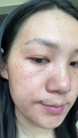 Hành Trình Giảm Tàn Nhang, Trắng Da #facehanako #hanako 