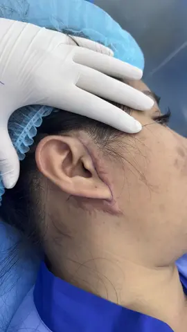 Xử lý sẹo căng da #sugery #operation #cangdamat #facelift #seo #scar 
