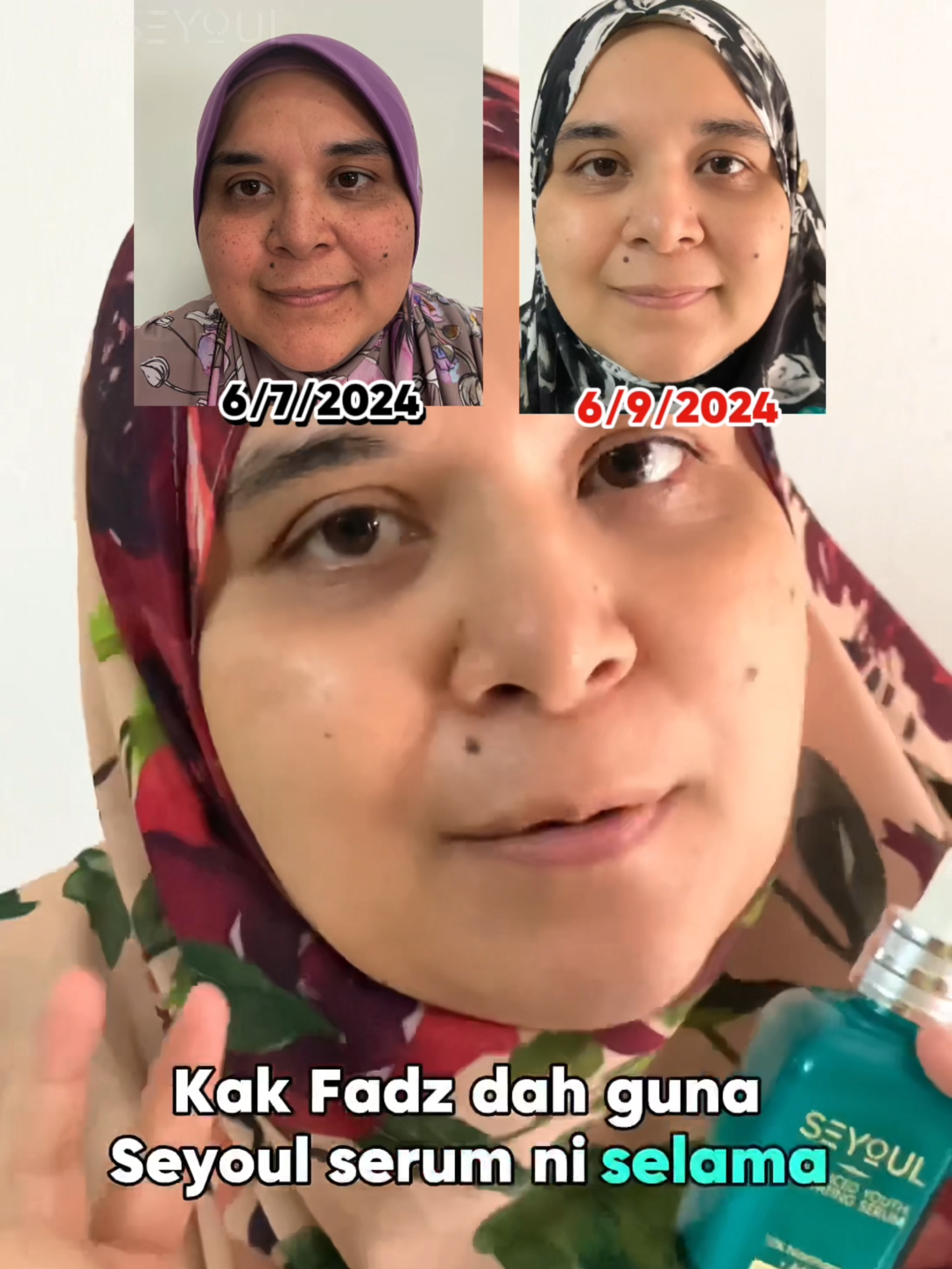 Perjalanan Pemulihan Kulit #seyoul #seyoulmalaysia #seyoulofficial #serumseyoul #melasmaserum