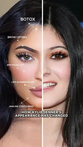Kylie Jenner has openly admitted to using lip fillers.Beyond these procedures, there has been widespread speculation about other cosmetic enhancements, such as rhinoplasty, cheek fillers, and jawline contouring, botox and e.t.c #botox#botoxdubai#fullface#fullfacebotox#russianlips#russianlipsdubai#beauty#celebrity#russianlipsqatar#botoxqatar#botoxlondon#fullfacelondon
