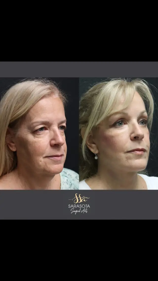 #facelift #cosmeticsurgeon #plasticsurgeonsoftiktok 