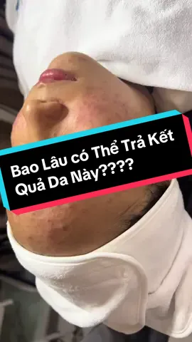 Được giới thiệu tới là biết spa chị Vân đtri da uy tín như nào rồi #skincare #spa #peeling #mụn 