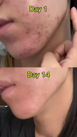 How I treat my acne in just two weeks! #acne #ledmask #ledlighttherapy #llskin