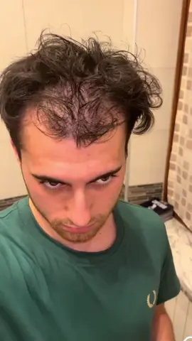 Hair growth essence can promote your hair to grow faster and increase the quantity 10 times#hairloss #postpar #haircare #pyl #haircut #hairgrowth #hairgrowthserum #hairgrowthproducts #hairgrowthsolution #hairoiling #fyp