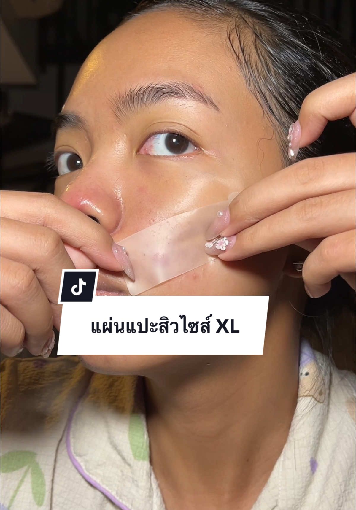 แผ่นแปะสิวไซส์ XL แปะสะใจมากแก #คุณรุ้งรีวิว  #แผ่นแปะดูดสิวXL #แผ่นแปะสิว #careq 