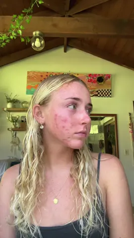 sorry this is my last one but why is acne so painful like my face is burning and i havent gotten a break and had clear skin in forever i feel like it will never leave #girl #relateable #relateblecontent #fyp #viral #blowthisup #boostthis #trending #trend #blonde #lockin #grwm #fypシ゚viral #fypシ #acne #sad #cry #tears #acneskin #hormonalacne #acnetips 