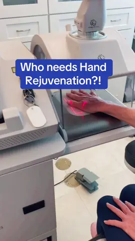 Laser Hand rejuvenation #laser #hands #younghand #fyp #co2laserskinresurfacing 