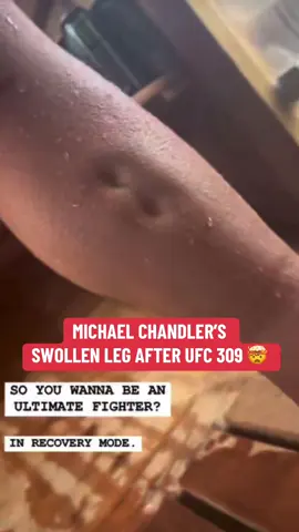 OUCH 😳 #UFC #mma #ufc309 #michaelchandler #charlesoliveira #injury (via mikechandlermma/IG)