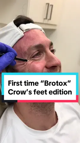 First time Botox plan focusing on smoothing & brightening the eye and undereye region. 10 units per side is all it takes 😌 results take 2 weeks ✅ #malebotox #brotox #botoxchicago #botoxplan #crowsfeet #botoxasmr #asmrappt #soothing #chicagoinjector #medspa #botoxboss 