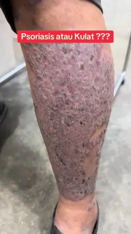 #fypシ゚viral🖤tiktok #fyp #jangkitankulat #fypシ゚viral #tineacorporis #fungalinfection #eczemaawareness #fypシ 