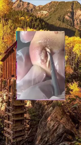 #toenails #ingrowntoenail #toenailremoval #nails #toenail #satisfyingvideo #fyp