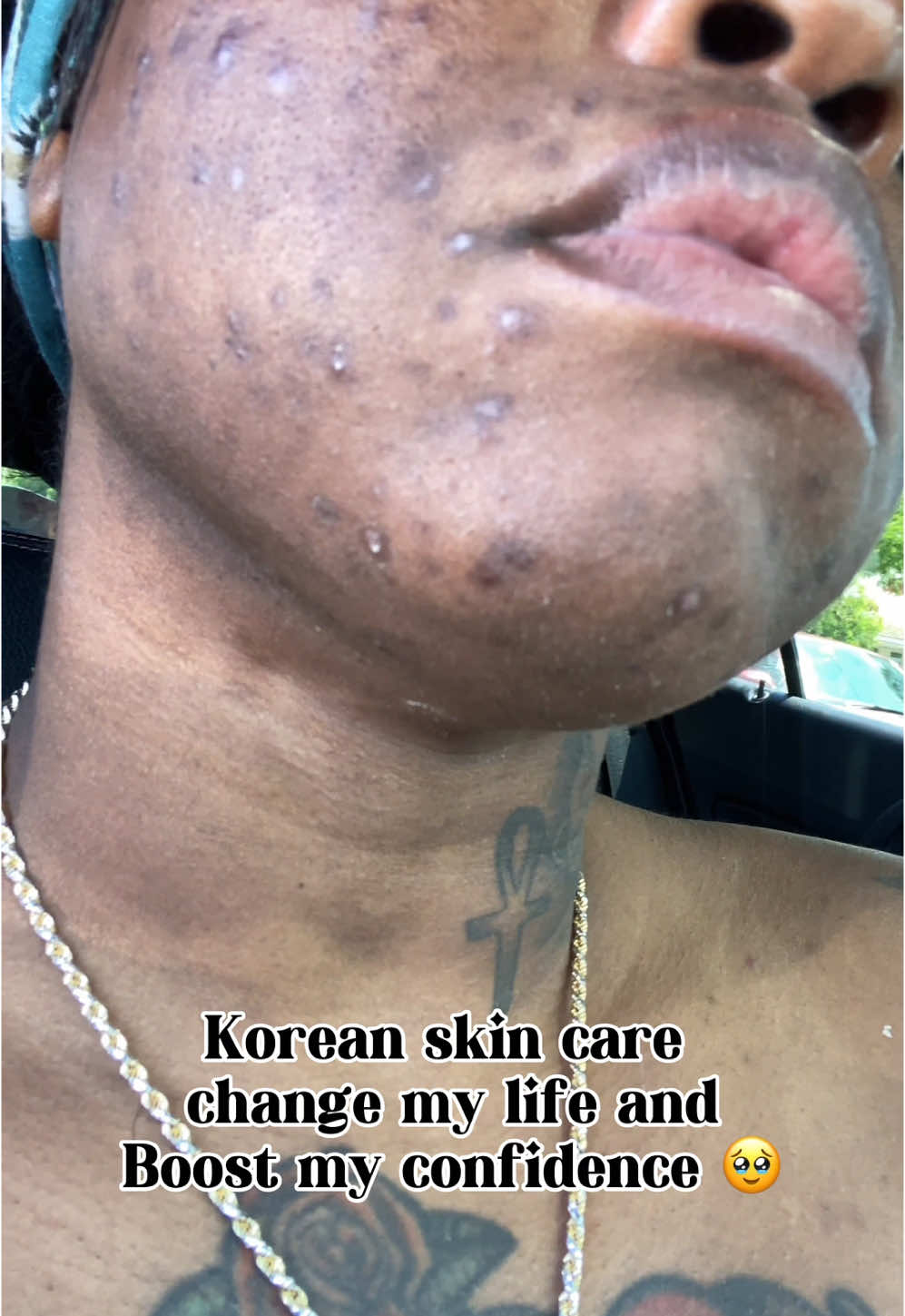 Lets talk about how acne can steal your joy, take your confidence and send you into depression. Have tried every product, dermatologist aestheticians, chemical pills you name it I’ve done it. I’ve finally found products that works for me. I only use Anua products and 1 other brand. Plus I take probiotics and enzymes. A good routine and a healthy gut is the key. ##acne##skincare