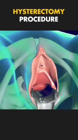 Hysterectomy Procedure 3D Animation #hysterectomy #hysterectomyrecovery #hysterectomyjourney #hysterectomycheck #hysteroscopy #uteruscancer #uterinecancer #uterinefibroid #medical3danimation #3dmedicalanimation 
