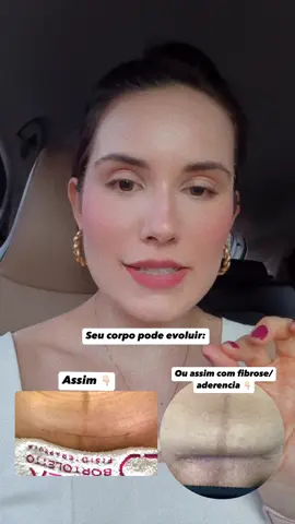 Entenda mais sobre Cicatriz cesariana 🦋 #cicatriz #posparto #pospartocesarea🤱 #fibrose #abdomenposparto #abdomen #partocesarea 