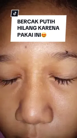 Replying to @dwi dzaki bukti langsung dari onty yang masalah bercak putih kulit anaknya hilang karena pakai Physical Sunscreen Moell😍 #moell #moellskincarebayi #sunscreenmoell #sunscreenanak 