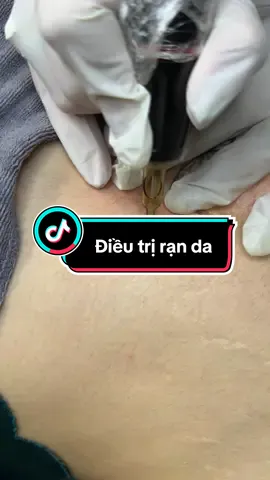 Rạn da sau sinh . #Điềutrịdakhoahọc #Laser #Trịmụn #Trịnám #mesocanchinhguongmat  #mesokhôngnốtsần   #Mesotherapy #Peeldakhoahọc #Dượcmỹphẩmchínhhãng #BAPnângcơ #Prp #Phụchồida #chămdakhoahoc #chuẩnykhoa #ứngdụngdượcmỹphẩm #Filler #Botox #Hifu #Laser #Mụn #Nám #TànNhang #BớtHori #ChemicalPeel #Spaquan3 #Trẻhoáda #triệtlôngquận3  #randa #randasausinh   