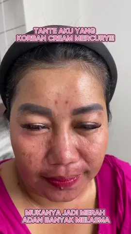 Siapa yang korban mercury seperti tante aku?? sini pakai cream brightening chalonese untuk dapatkan kulit sehat impianmu🤗🤗 #chalonesebrigteningcream #paydaysale #wibgajian #skincarebpom #dreamskin