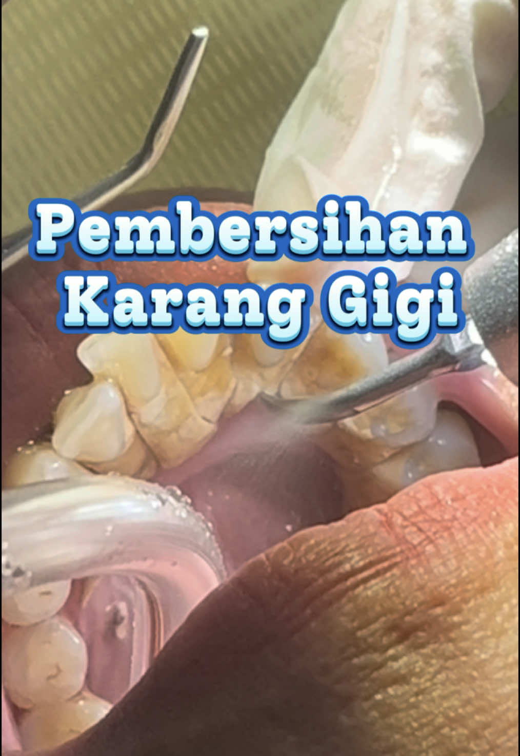 Pembersihan karang gigi pada kasus berat, hampir semua giginya goyang akibat infeksi dari karang gigi. Yuk bersihkan sebelum parah😉 #doktergigipekanbaru #scalinggigi #doktergigi #karanggigi 