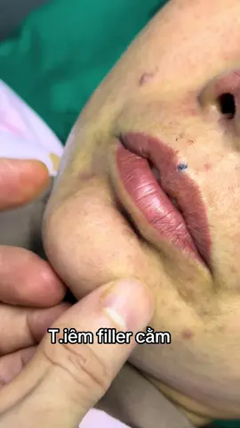 #nangmui #xuhuong #bsphamhao #suamuihong #gheptrungbi #lamdep 