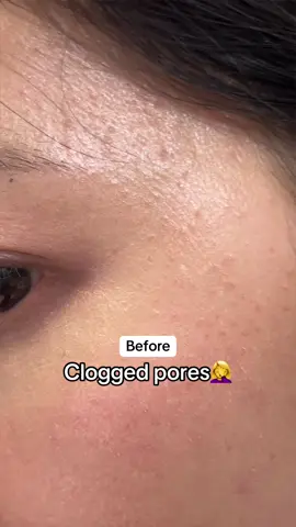 😩I hate clogged pores. This 3-in-1 cleanser saved my skin from clogged pores.✨ #redence #glowskin #claymask #mudmask #glassskin #kbeauty #koreanskincare #cleanser #cleansing #facepack #washoffpack #managerpore #pore @redence_us