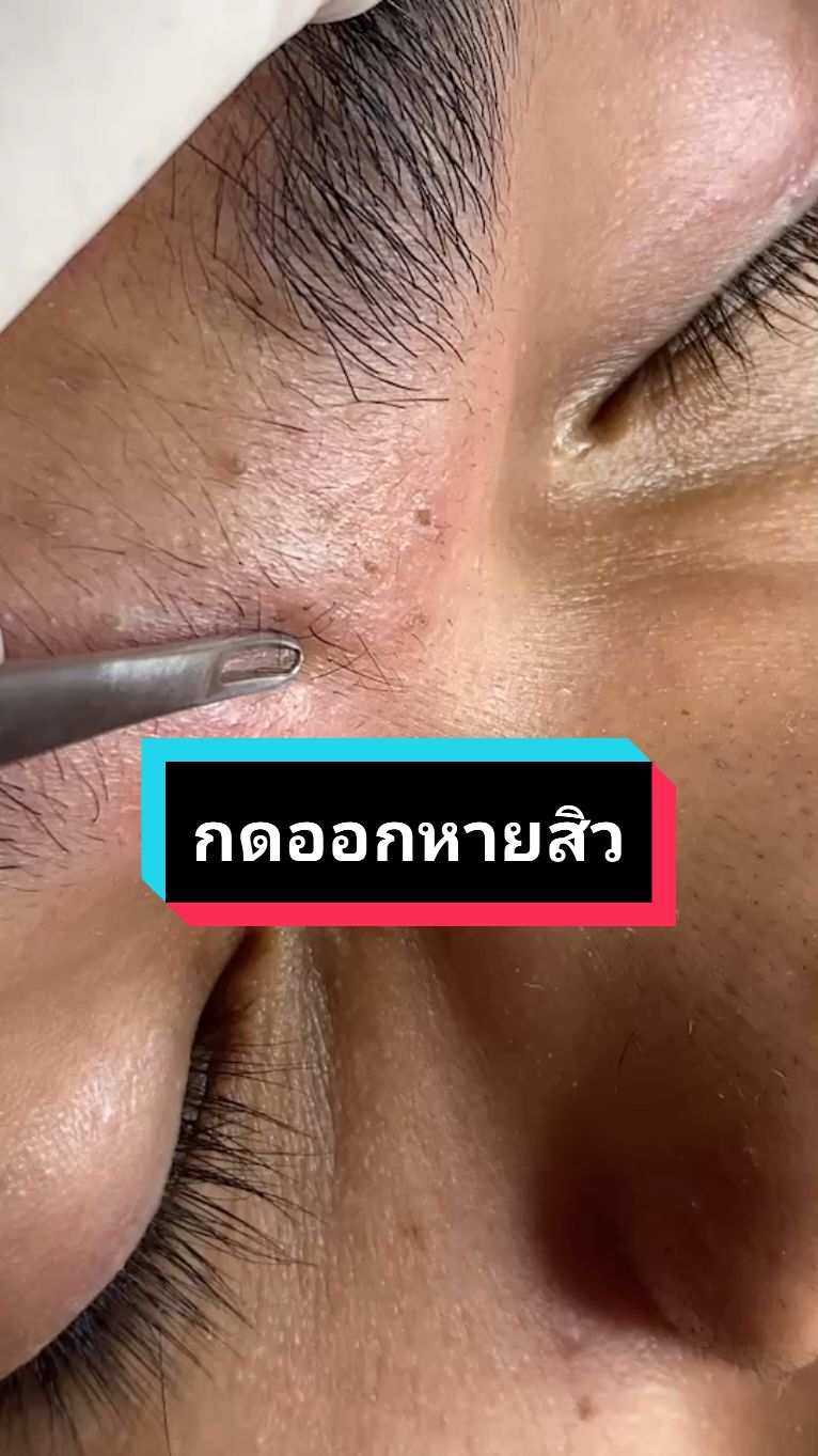 #กดสิว #สิวอุดตัน #กดสิวอุดตัน #กดออกหายสิว#นักปั้นอาชีพกดสิว #พี่กุ้งกดสิว #เทคนิคพี่กุ้งกดสิว #สอนดูผิว #สิว #ลูกศิษย์พี่กุ้ง #ceoพี่กุ้งกดสิว #tiktokuni #เมนูดังtiktok #สอนกดสิว #กดสิวมืออาชีพ  #ได้ความรู้แบบเพลินๆ 