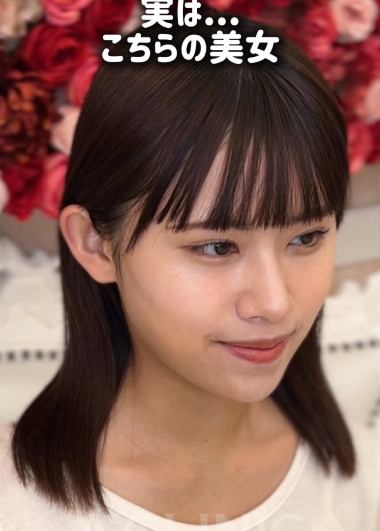 腫れのピークの3日目でもこの腫れの少なさ🫣周りにバレずに小顔になるなら1day小顔®︎✨ #脂肪吸引#顔の脂肪吸引#小顔#小顔脂肪吸引#1day小顔#aclinic#垢抜け#ダウンタイム