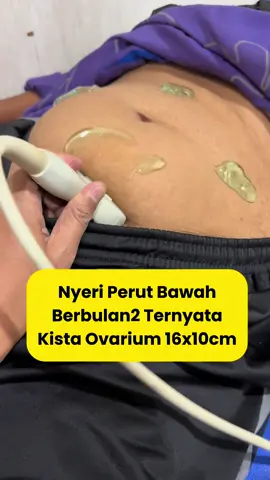 #kista #ovarium #tumor #wanita #rsbudiasihcikarang #bedah #nyeri #perut #bawah 