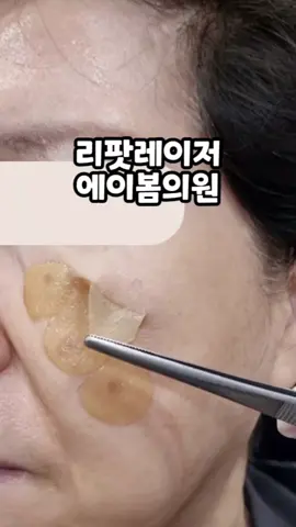 리팟레이저 흑자를 레이저 시술 1번으로 제거할 수 있을까요?