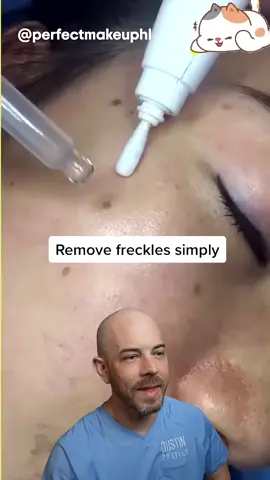 Make sure to watch out for this dubious freckle remover  - #squeezeyuk #acne #pimple #pimplepop #blackhead #satisfying #foryoupage #foryou  #تنظيف_بشره  #whiteheads #رؤوس_سوداء #عنايه_بالبشره #دهون 