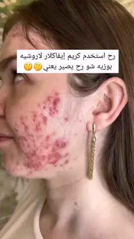 #ايفاكلار #حب_شباب 