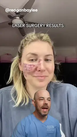 Amazing laser surgery results!  - #squeezeyuk #acne #pimple #pimplepop #blackhead #satisfying #foryoupage #foryou  #تنظيف_بشره  #whiteheads #رؤوس_سوداء #عنايه_بالبشره #دهون 