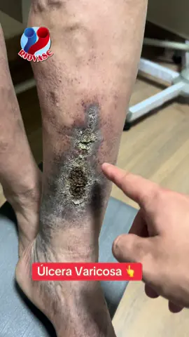 🏩 La Úlcera Varicosa 😱👆 es consecuencia de no tratar tus Várices a tiempo @The Vein Doctor 👨‍⚕️ es de difícil cicatrización y puede infectarse  y afectar planos profundos incluso tejido óseo 👉 Ecuador - Riovasc 👈 📲+593995178395/+593958757917 #ulceravaricosa #varices #ulceravenosa #varicesenlaspiernas #venasvaricosas #cristianbravo148 #cirugiavascular 