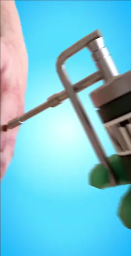 How a wart is frozen off🥶#zackdfilms #edit #fyp #wart 