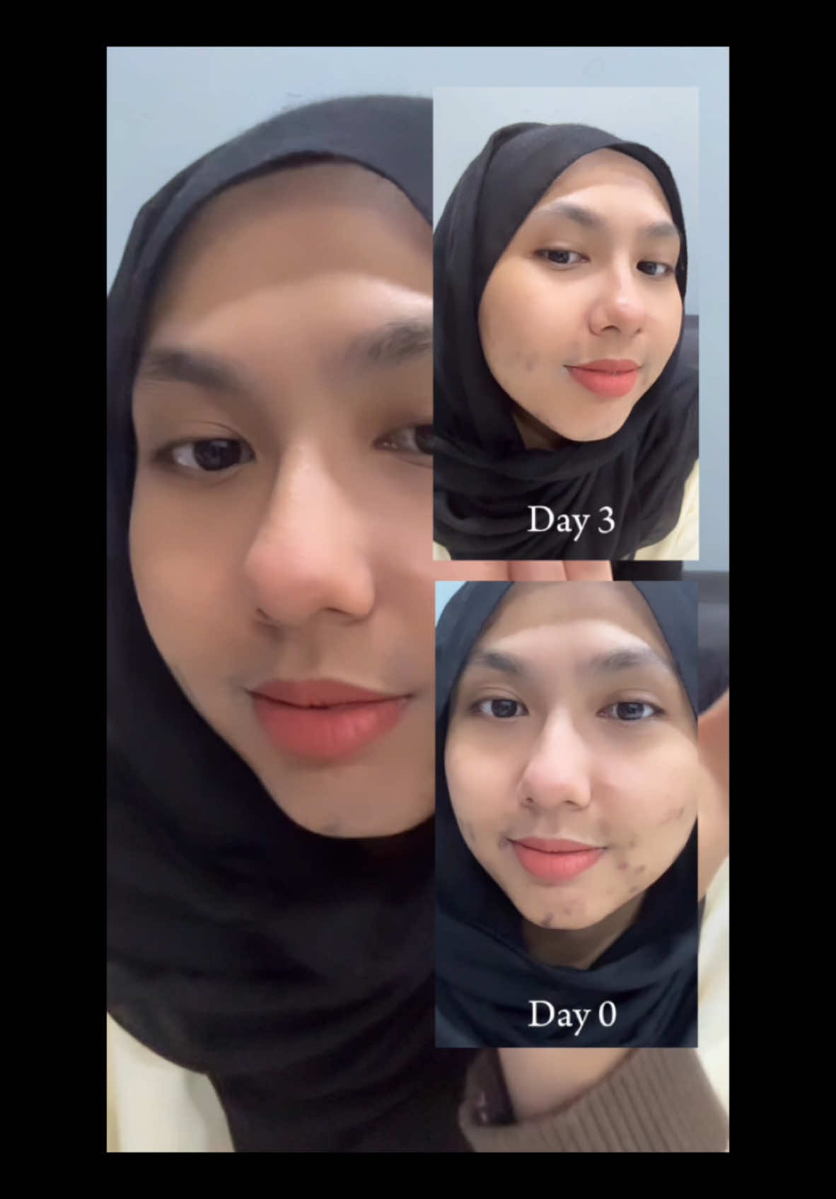 🎥 How I Faded My Dark Spots in Just 3 Days! @GarnierMY  Say goodbye to dark spots with the Garnier Bright Complete Vitamin C+ Serum—my ultimate dark spot reducer! 🌟 This serum is not only 30x stronger, but it’s also 100% HALAL! Your journey to better and brighter skin starts here. 💛 ✨ Why I Love It ✔ 100% Halal ✔ 30x Vitamin C power ✔ Visible results in just 3 days 🌿 Don’t wait! Buy for a better skin today and see the magic yourself! #GarnierMalaysia #GarnierMY #GarnierSkincare #GarnierBrightSerum 