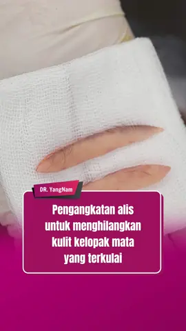 Brow lift to remove sagging skin that obscures vision of the eyes #opmata #eyelid #comesticsurgery #indonesia #malaysia #tiktokindonesia #dryangnam #fybシ 
