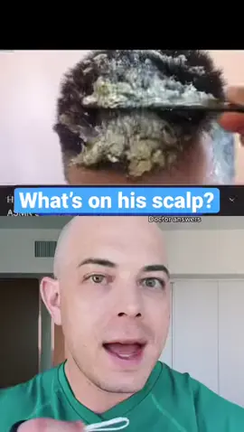 Is this even real -- #squeezeyuk #acne #pimple #pimplepop #blackhead #satisfying #foryoupage #foryou  #تنظيف_بشره  #whiteheads #رؤوس_سوداء #عنايه_بالبشره #دهون 