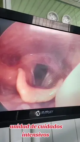 #endoscopia  laringea de emergencia 