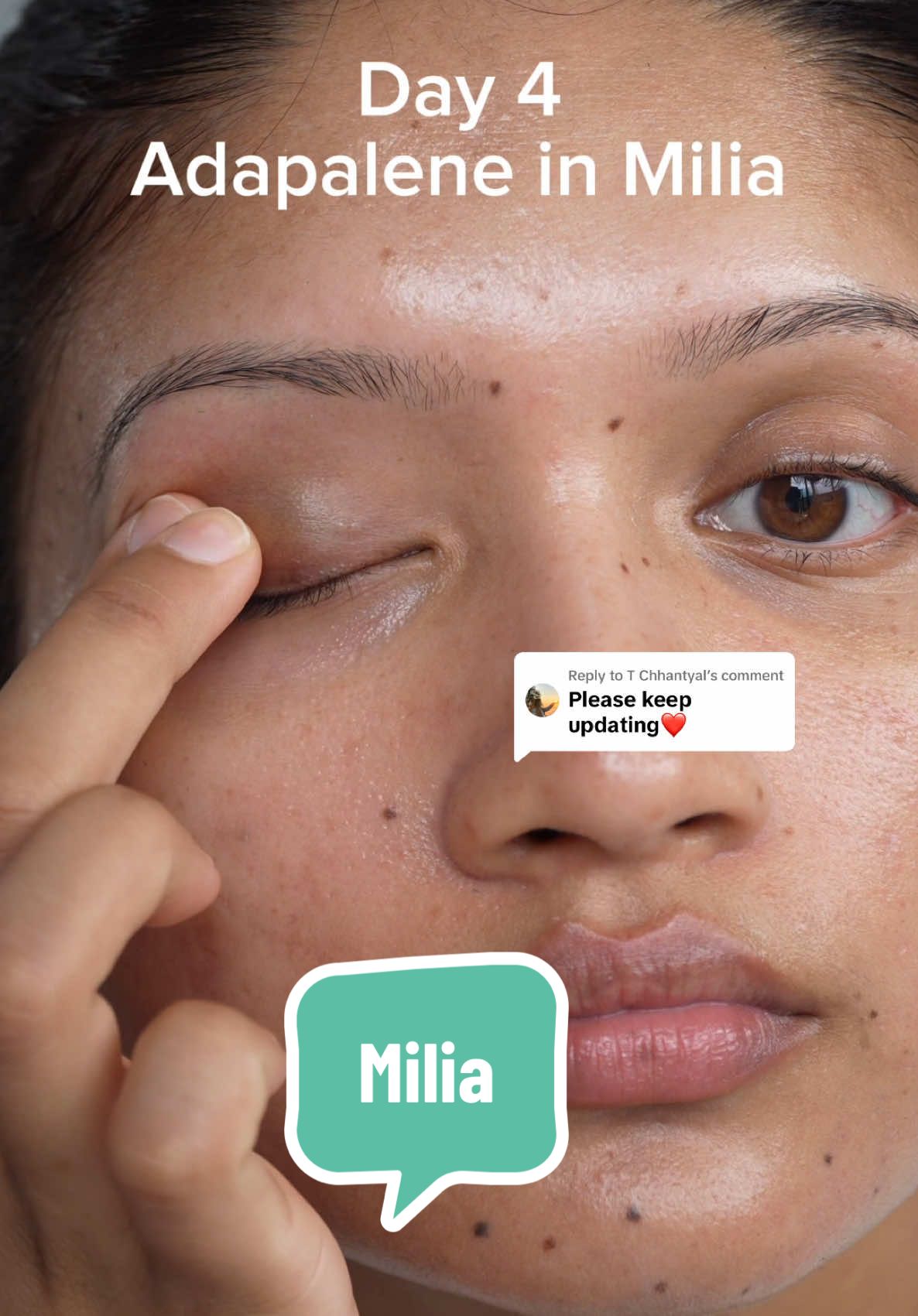 Replying to @T Chhantyal Day 4 of using adapalene on my milia.  It’s so much better now compared to when I started—completely gone, with just a mark left! #milia #miliaremoval #miliatreatment 