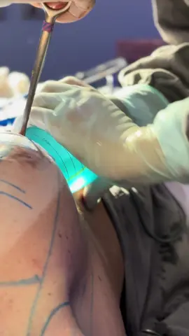 Preparacao e inserção de protese de silicone ✨ #mamoplastia #funildekeller #dradenisetorejane #silicone #gripplane #fiofarpado #silicone #cirurgiaplastica #protesedesilicone #prótesemamária🤩 #TécnicaR24R #LiftingDeSeios #PróteseMamária #Mastopexia #CirurgiaMamária #AutoestimaFeminina 