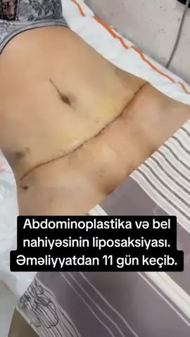 Abdominoplastika və bel nahiyəsinin liposaksiyası. Əməliyyatdan 11 gün keçib.
