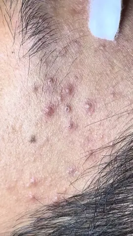 BaBo #nặnmụnbằngtay #lấymụnbằngtay #spamụnquận12 #thâmmụn #mụnquận12 #spanặnmụnquận12 #spamụn #thâmmụn #spamụn 