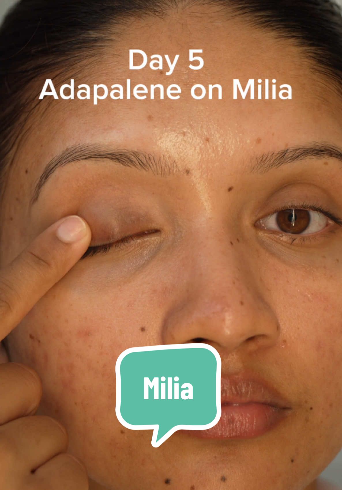 Day 5 of Adapalene, and my milia is gone ✌️  #milia #miliatreatment #miliaremoval 